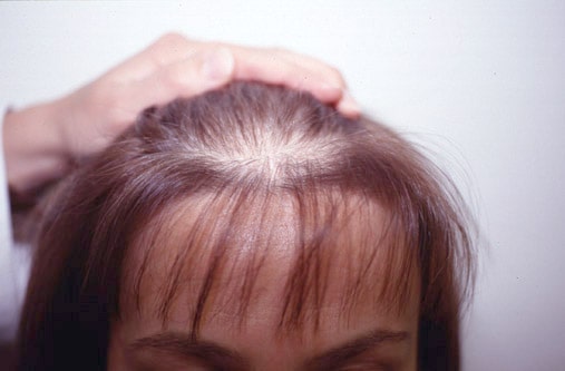 alopecia feminina