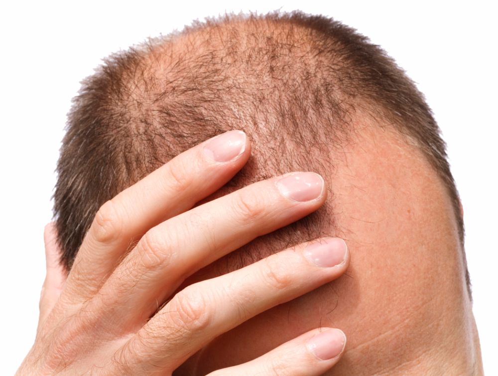 implante de fios e queda